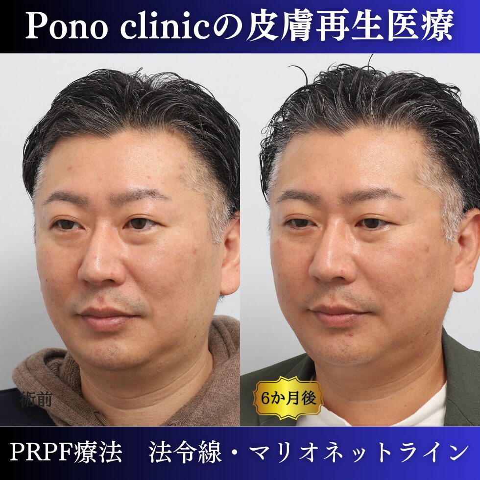 法令線、マリオネットライン、しわ治療、PRPF療法、40代男性の症例 (2)