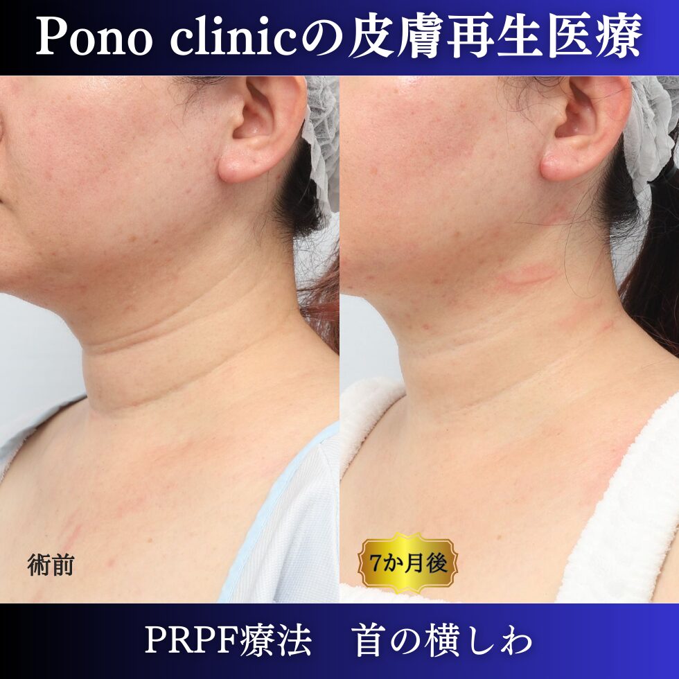 首のしわ、PRPF療法、 40代の症例(4)