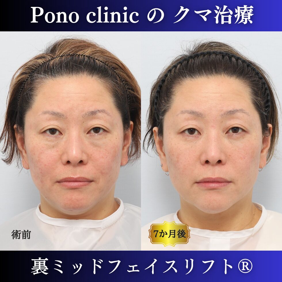 目の下のクマ治療、裏ミッドフェイスリフト、40代女性の症例 (7)