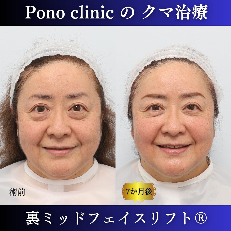 目の下のクマ、目の下のたるみ、クマ取り、裏ハムラ、裏ミッドフェイスリフト、50代症例 (4)