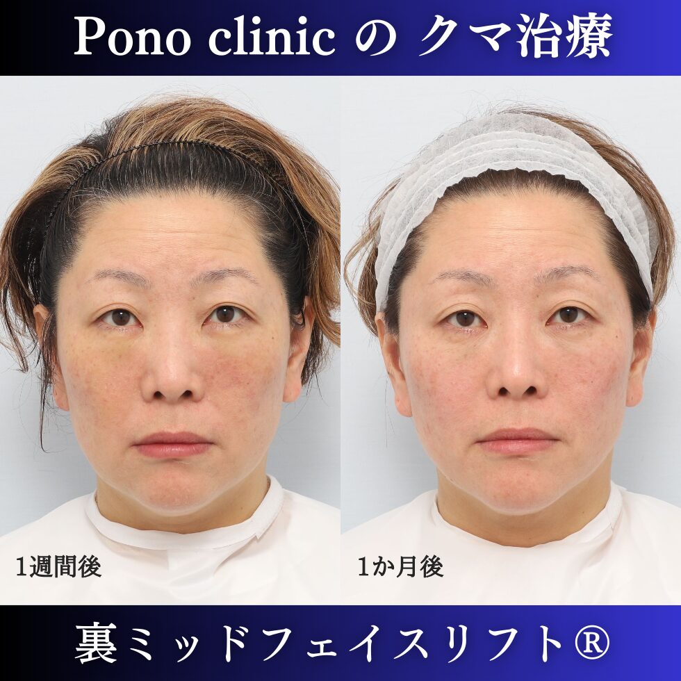 目の下のクマ治療、裏ミッドフェイスリフト、40代女性の症例 (1)