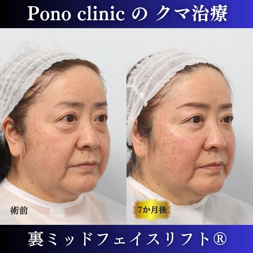 目の下のクマ、目の下のたるみ、クマ取り、裏ハムラ、裏ミッドフェイスリフト、50代症例 (2)