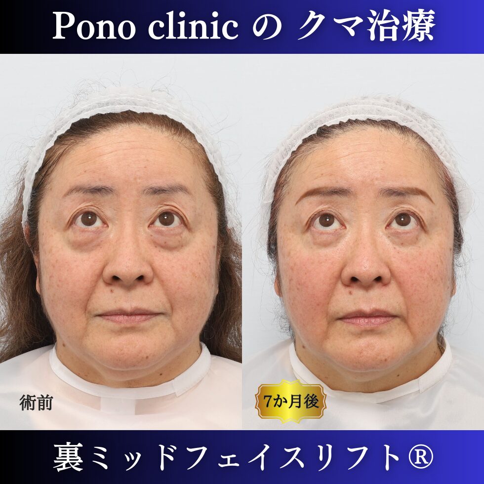 目の下のクマ、目の下のたるみ、クマ取り、裏ハムラ、裏ミッドフェイスリフト、50代症例 (5)