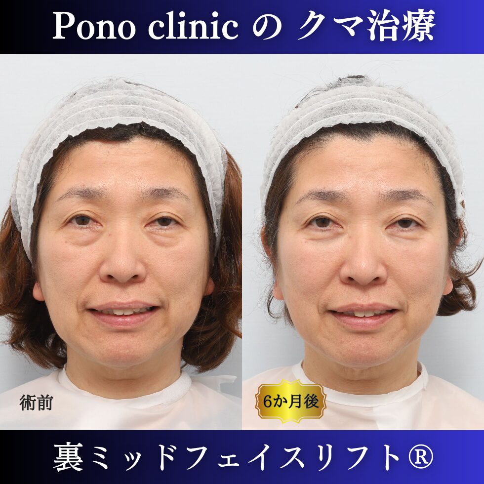 目の下のクマ、目の下のたるみ、クマ取り、裏ミッドフェイスリフト、50代症例 (4)