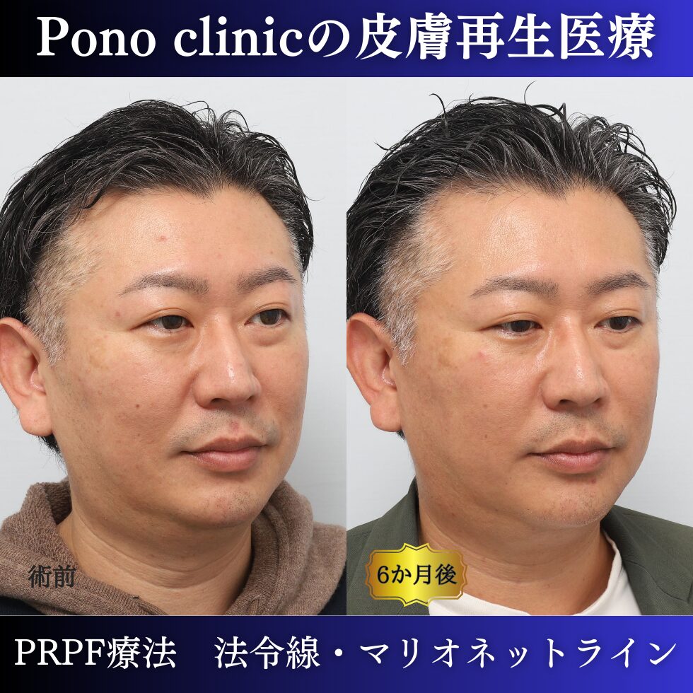 法令線、マリオネットライン、しわ治療、PRPF療法、40代男性の症例 (1