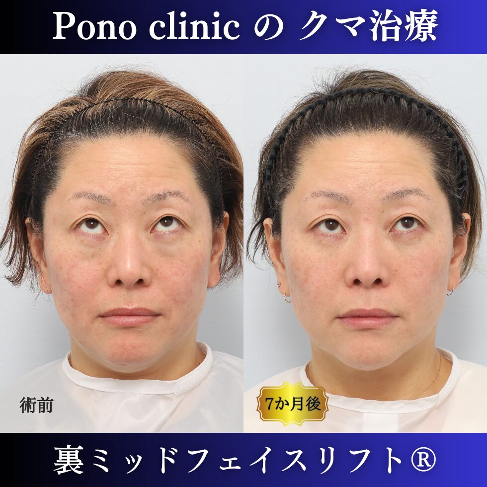 目の下のクマ治療、裏ミッドフェイスリフト、40代女性の症例 (5)