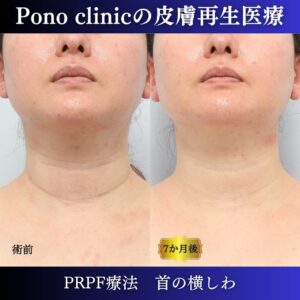 首のしわ、PRPF療法、 40代の症例(5)