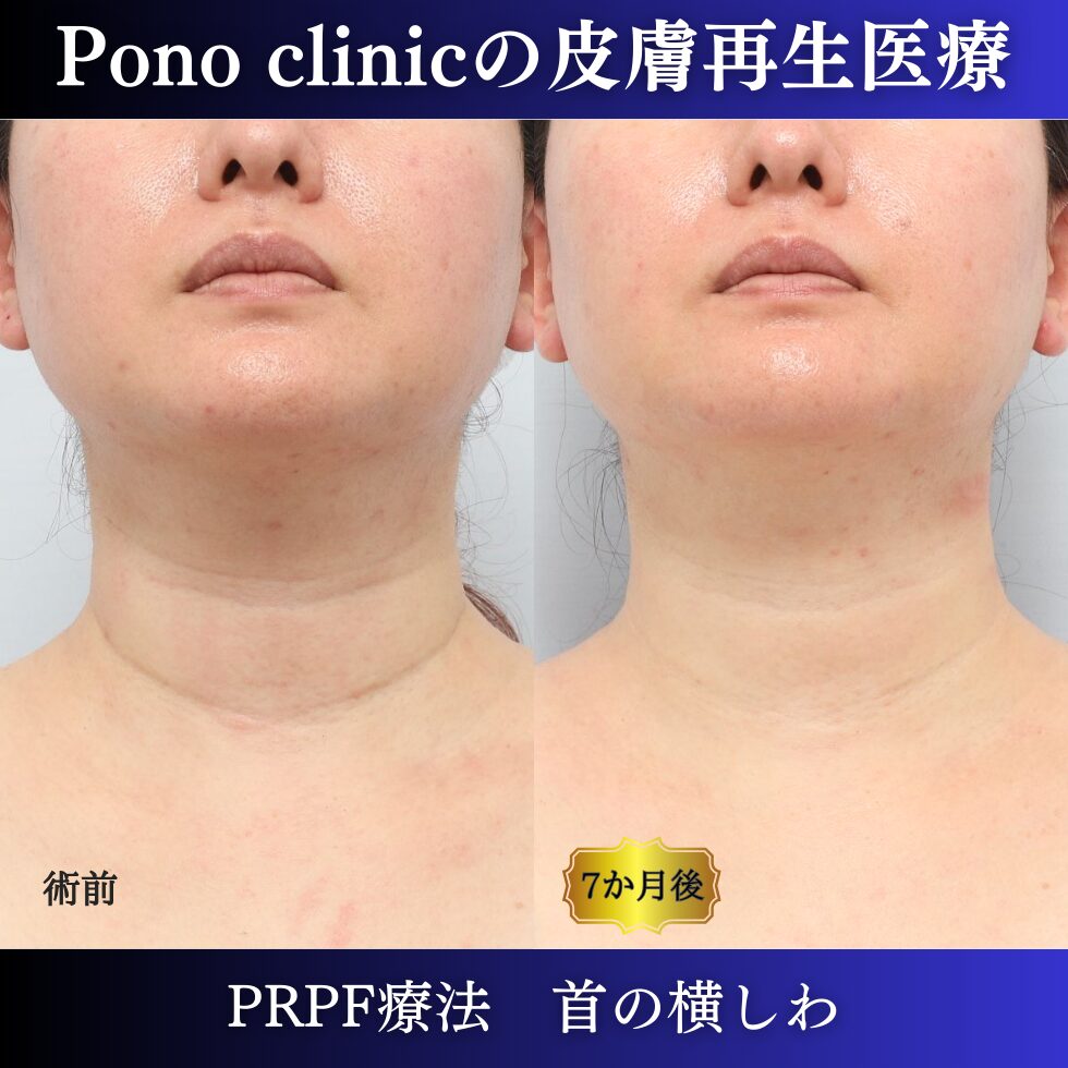 首のしわ、PRPF療法、 40代の症例(5)