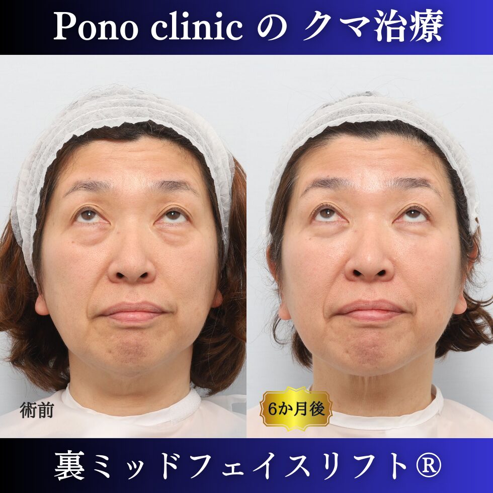 目の下のクマ、目の下のたるみ、クマ取り、裏ミッドフェイスリフト、50代症例 (5)