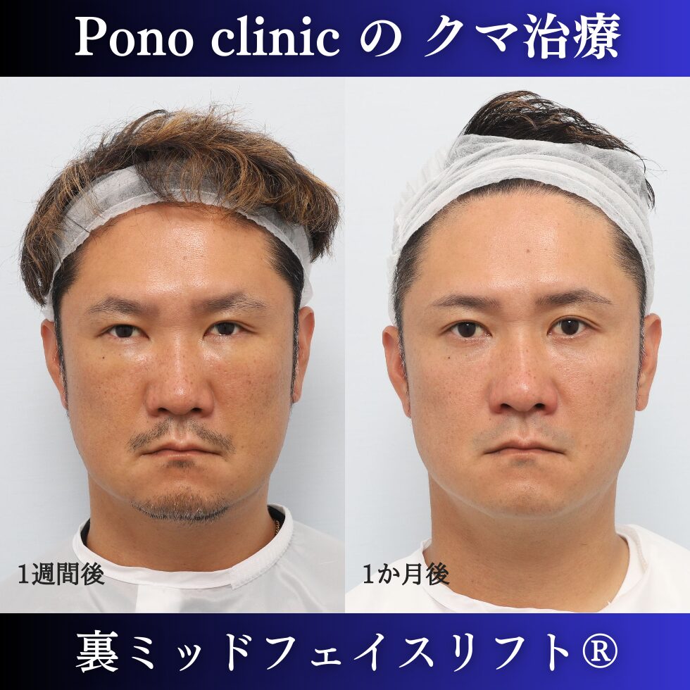 目の下のクマ取り、裏ミッドフェイスリフト、40代男性の症例 (1)