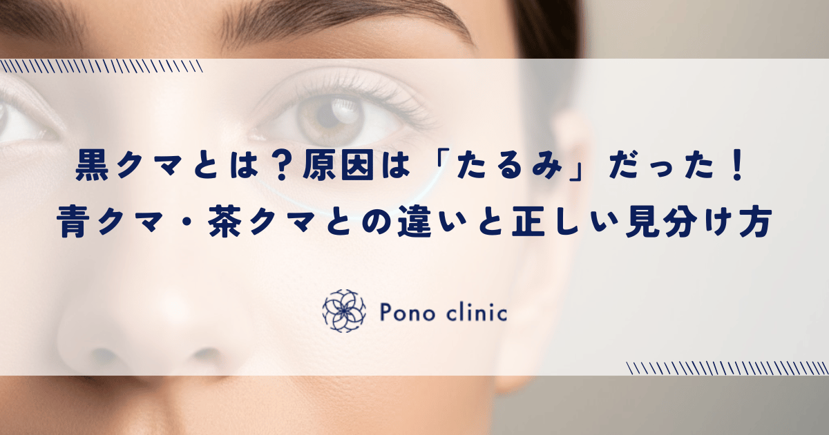 黒クマとは？原因は「たるみ」だった！青クマ・茶クマとの違いと正しい見分け方