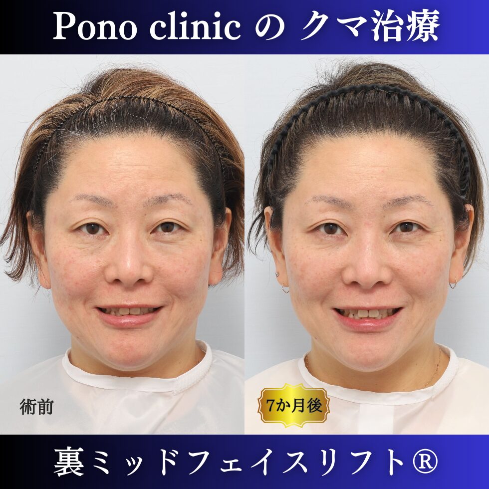 目の下のクマ治療、裏ミッドフェイスリフト、40代女性の症例 (4)