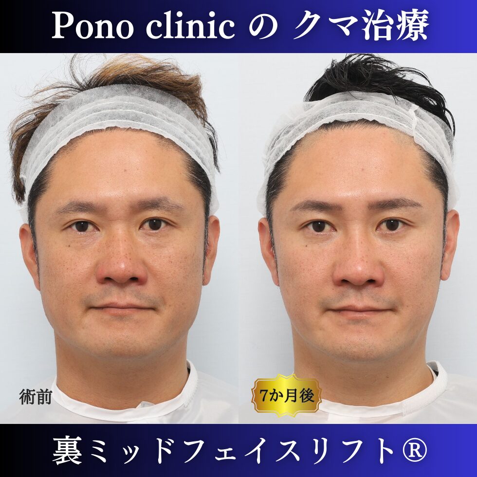 目の下のクマ取り、裏ミッドフェイスリフト、40代男性の症例 (5)