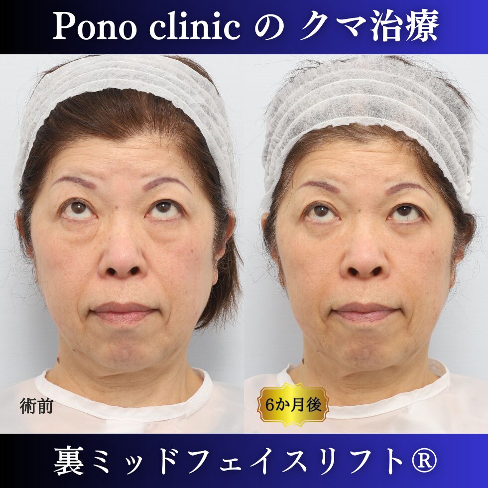 目の下のクマ、目の下のたるみ、裏ミッドフェイスリフト、60代症例 (5)