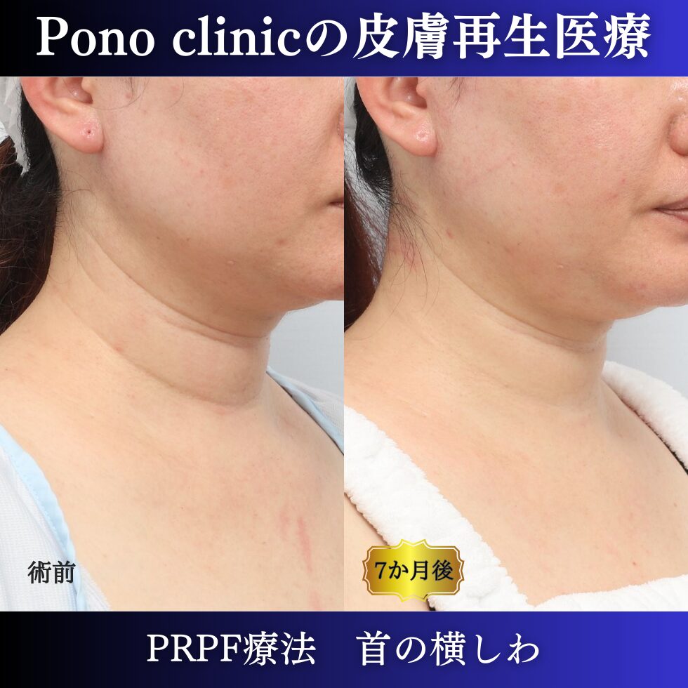 首のしわ、PRPF療法、 40代の症例(2)