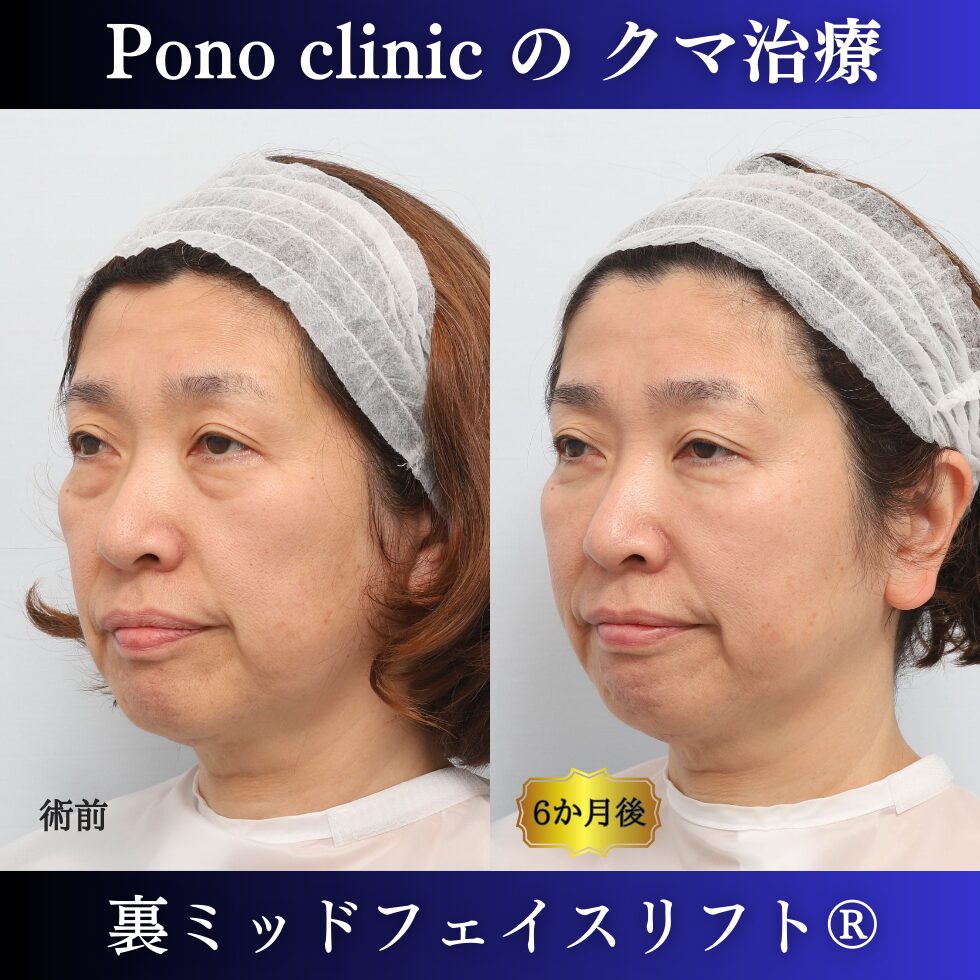 目の下のクマ、目の下のたるみ、クマ取り、裏ミッドフェイスリフト、50代症例 (3)