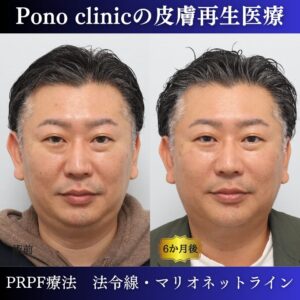 法令線、マリオネットライン、しわ治療、PRPF療法、40代男性の症例 (4)
