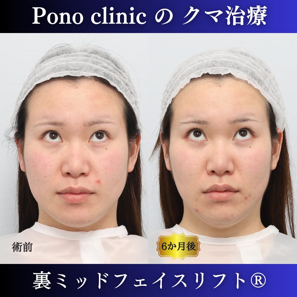 目の下のクマ治療、裏ハムラ、裏ミッドフェイスリフト、20代症例 (5)