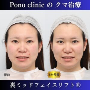目の下のクマ治療、裏ハムラ、裏ミッドフェイスリフト、20代症例 (4)