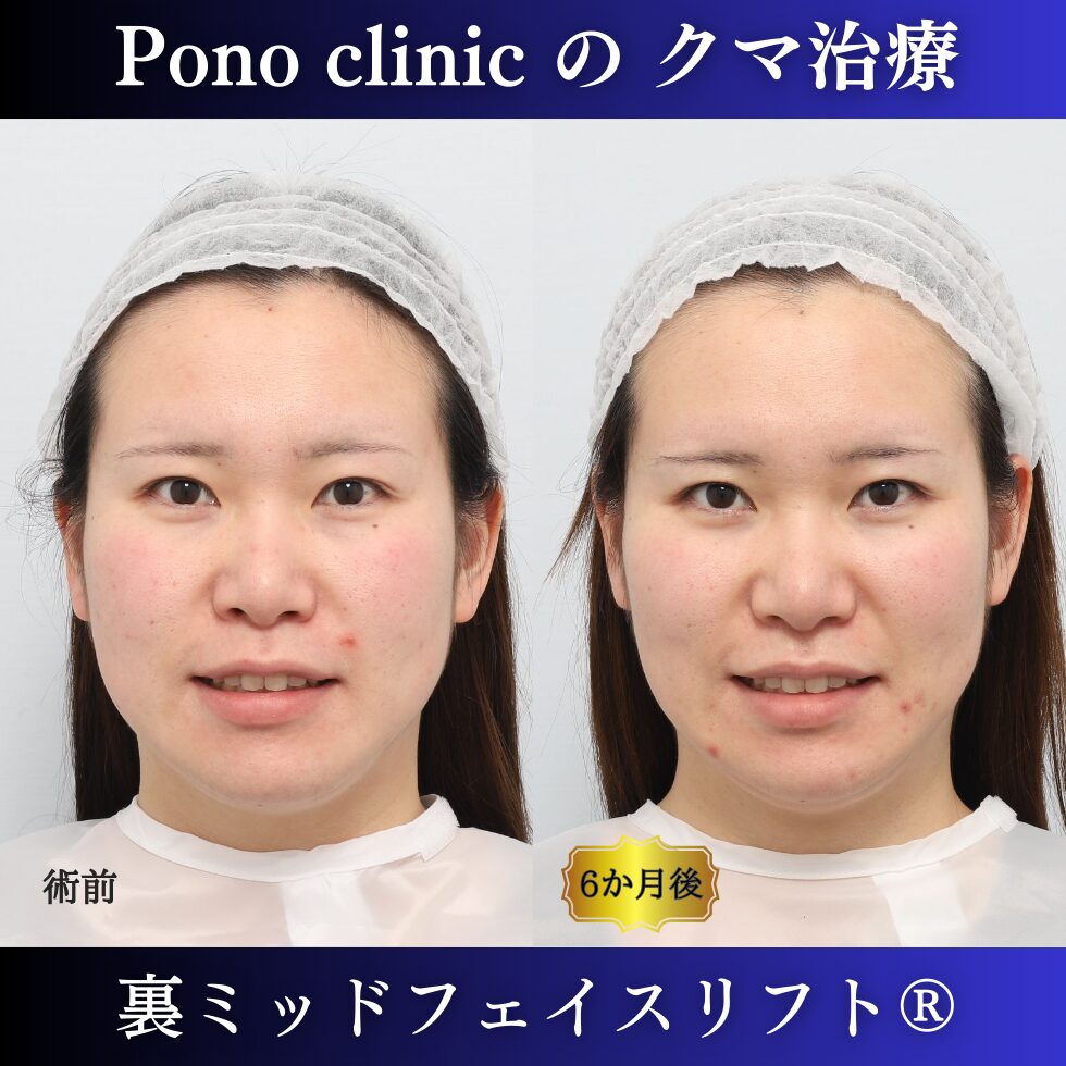 目の下のクマ治療、裏ハムラ、裏ミッドフェイスリフト、20代症例 (4)