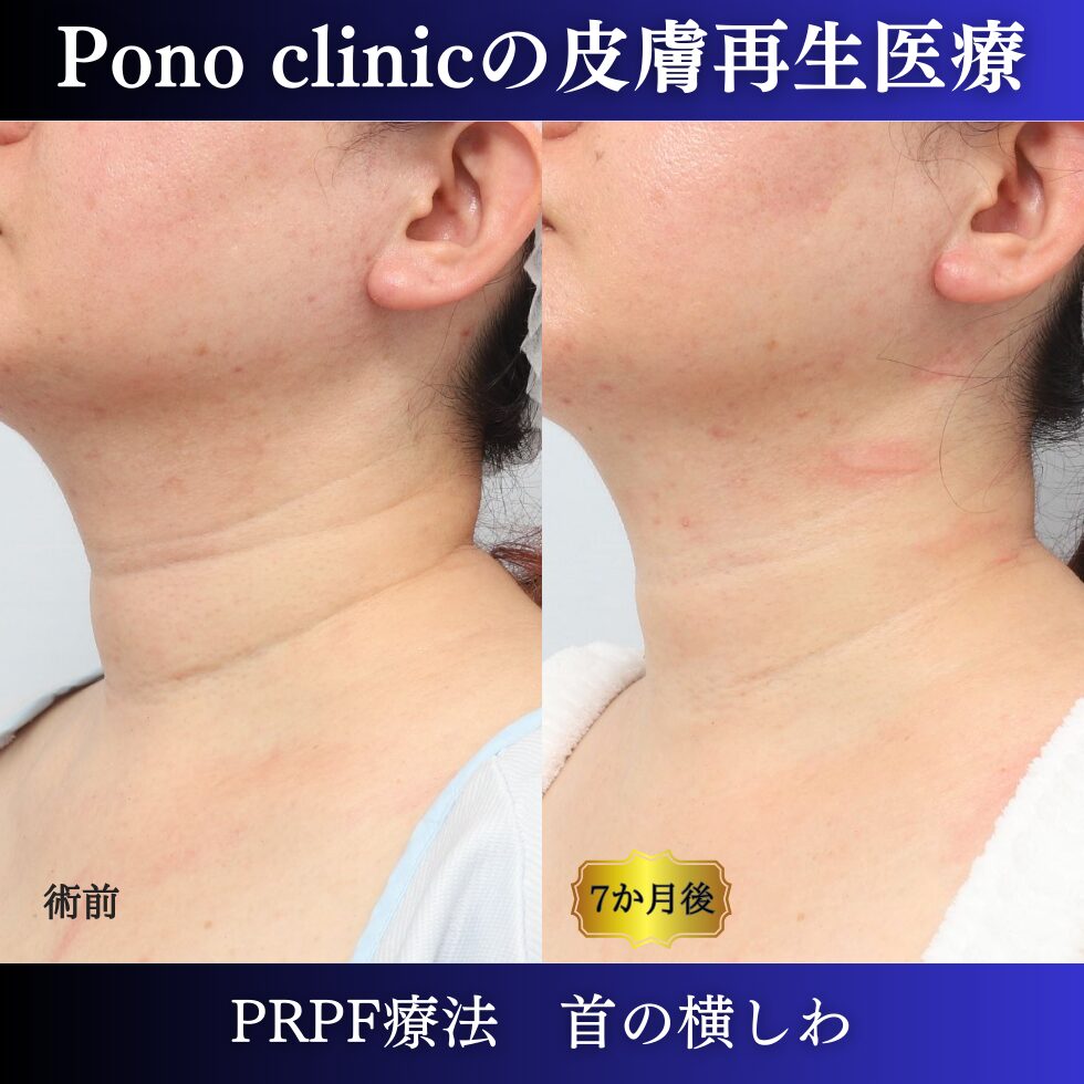 首のしわ、PRPF療法、 40代の症例(3)