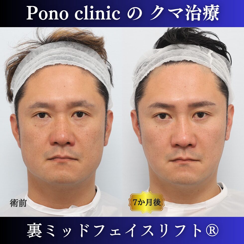 目の下のクマ取り、裏ミッドフェイスリフト、40代男性の症例 (7)