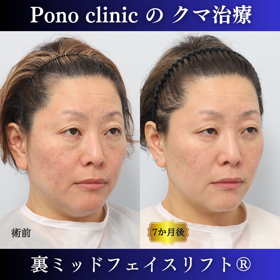 目の下のクマ治療、裏ミッドフェイスリフト、40代女性の症例 (2)