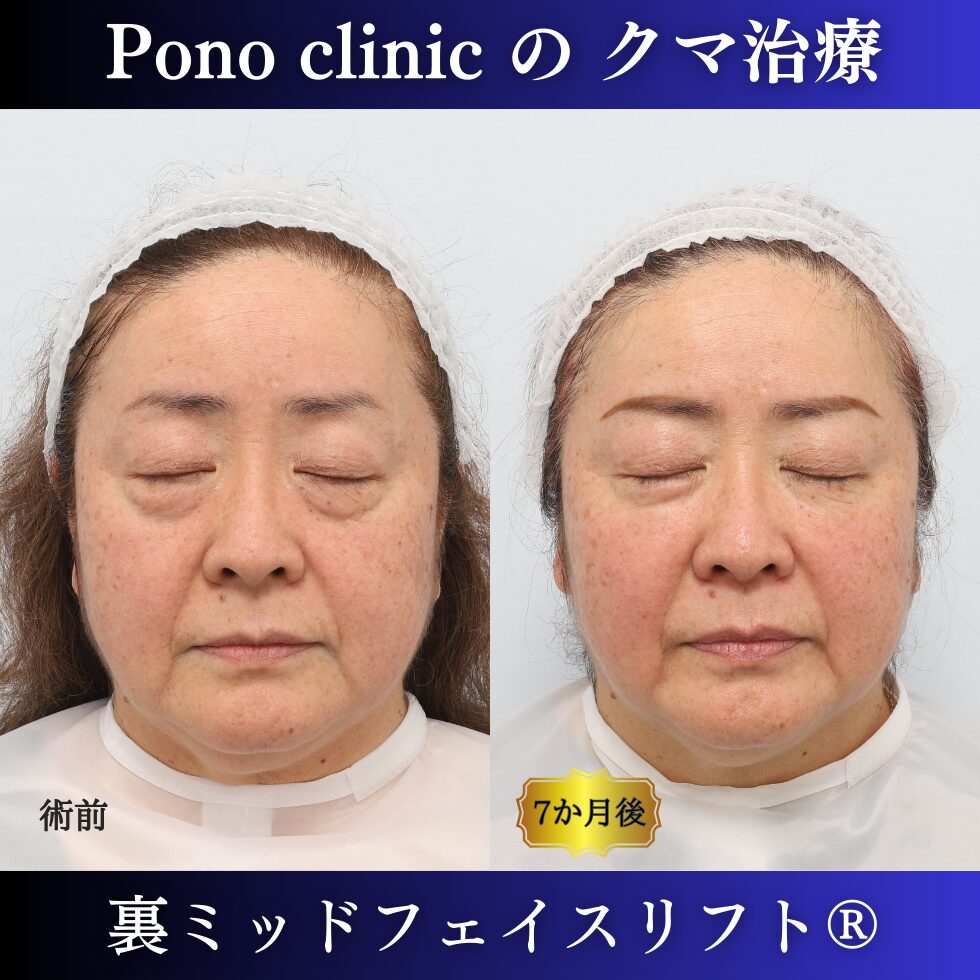 目の下のクマ、目の下のたるみ、クマ取り、裏ハムラ、裏ミッドフェイスリフト、50代症例 (6)