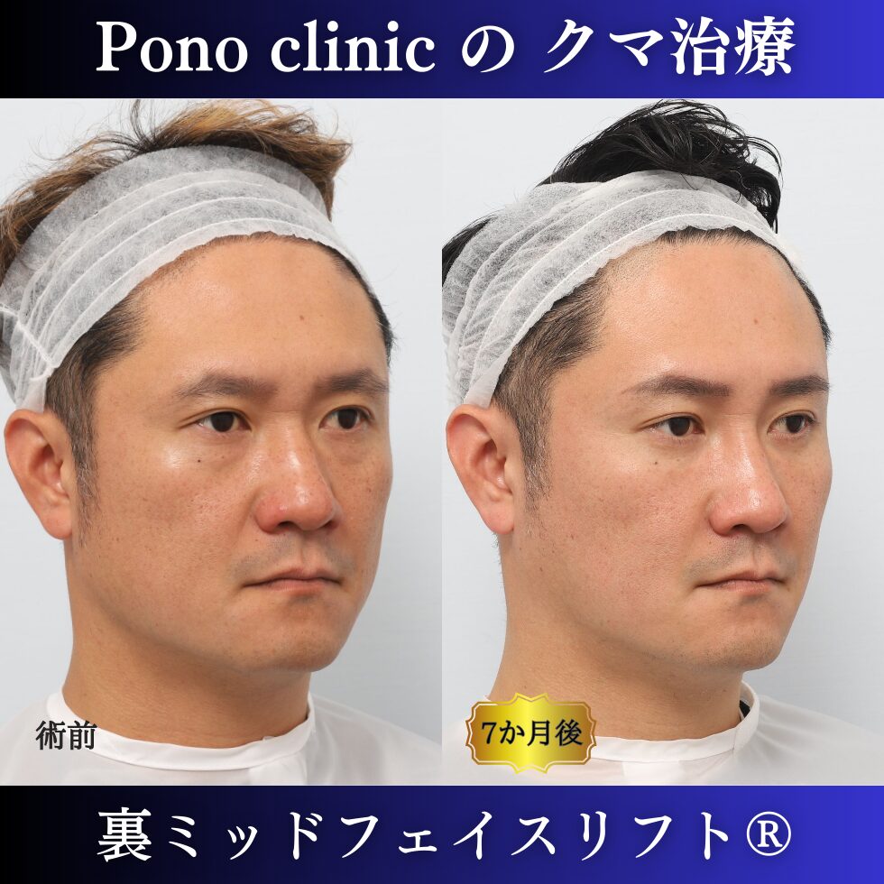 目の下のクマ取り、裏ミッドフェイスリフト、40代男性の症例 (2)