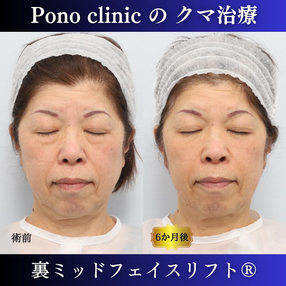 目の下のクマ、目の下のたるみ、裏ミッドフェイスリフト、60代症例 (6)