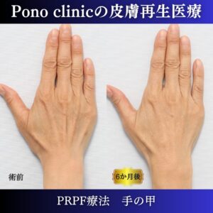 手の甲、PRPF療法、50代の症例 (3)
