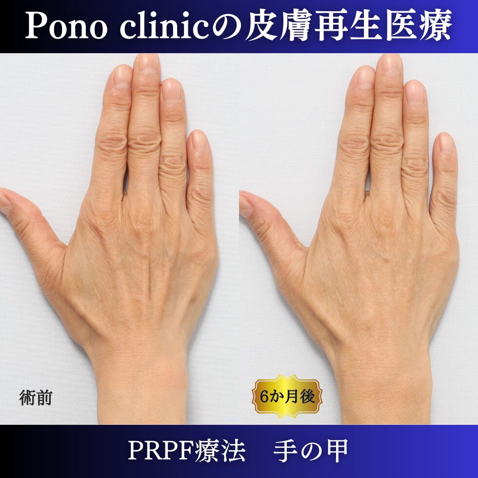 手の甲、PRPF療法、50代の症例 (3)