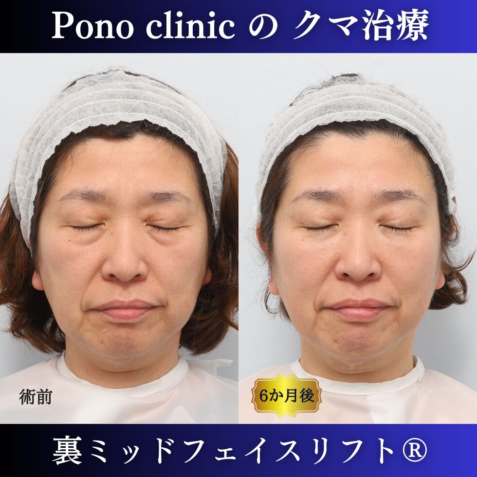 目の下のクマ、目の下のたるみ、クマ取り、裏ミッドフェイスリフト、50代症例 (6)