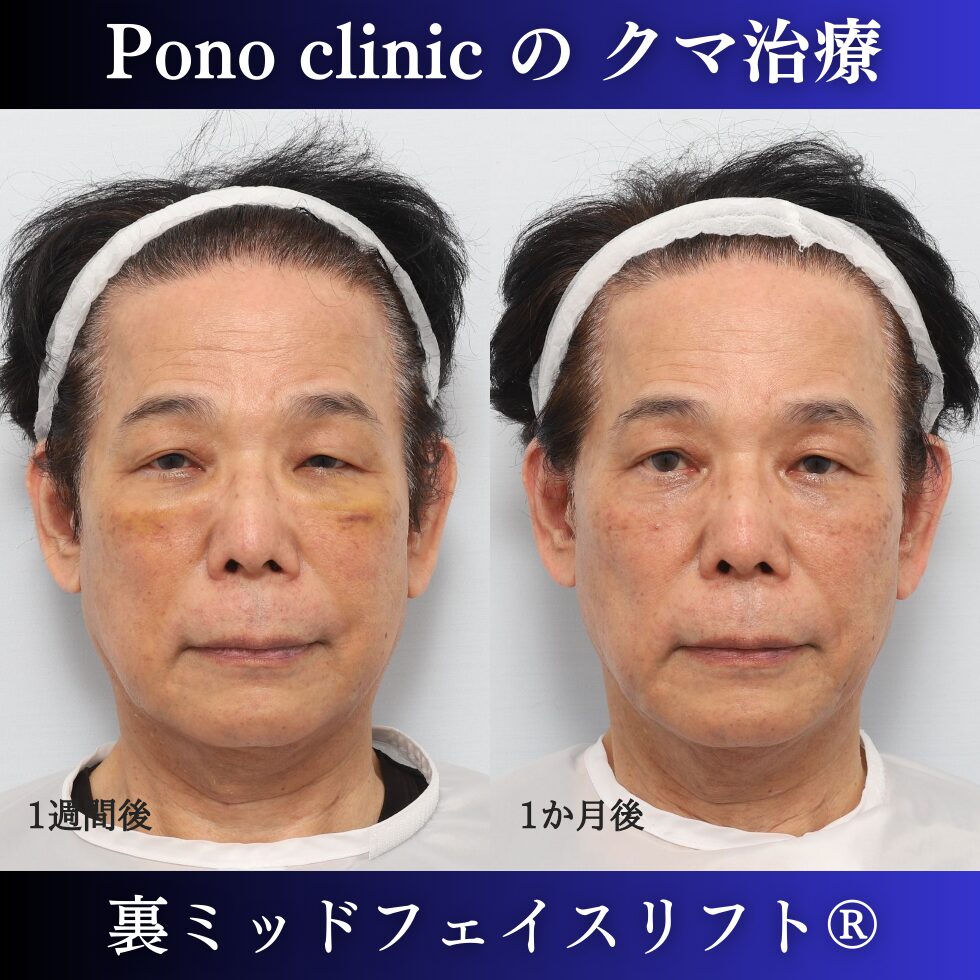 男性のクマ治療、50代の症例、目の下のたるみ、目の下のクマ、黒クマ (1)