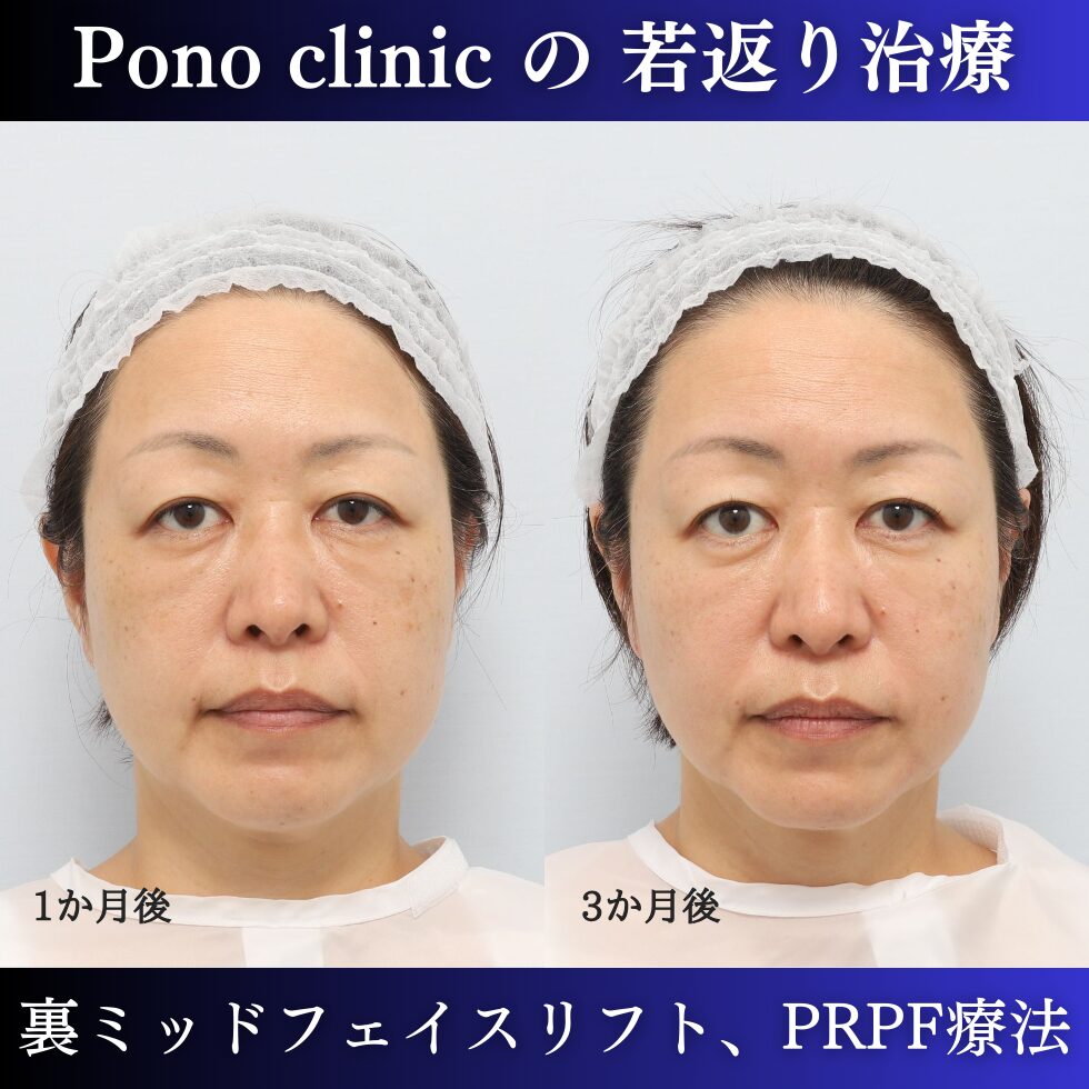 裏ミッドフェイスリフト、PRPF療法、クマ治療、眉間のしわ、額のしわ、コメカミの凹み、50代の症例 (1)