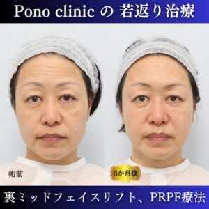 裏ミッドフェイスリフト、PRPF療法、クマ治療、眉間のしわ、額のしわ、コメカミの凹み、50代の症例 (7)