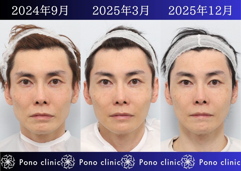 PRPF療法、若返り治療、しわ治療、法令線、目の上のくぼみ、頬コケ、40代男性の症例 (7)