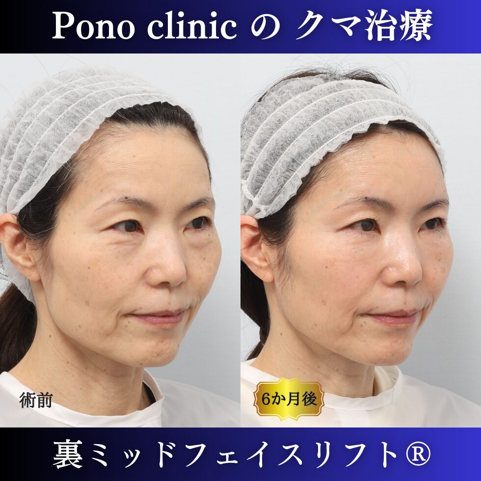 裏ミッド、PRPF額こめかみ眉間 (2)