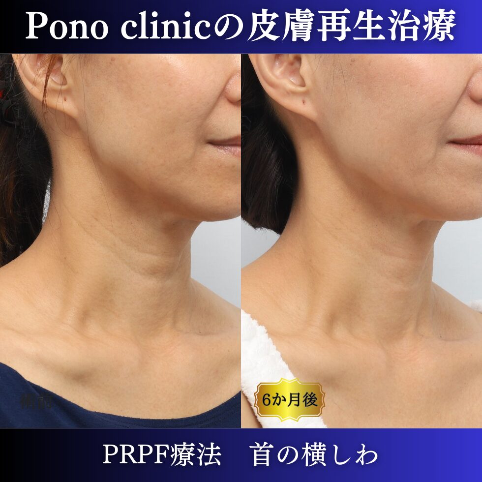 首のしわ、しわ治療、PRPF、50代の症例 (4)