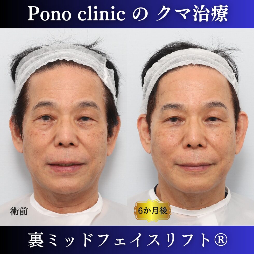 男性のクマ治療、50代の症例、目の下のたるみ、目の下のクマ、黒クマ (4)