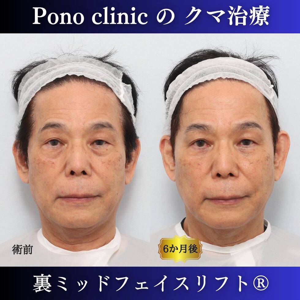 男性のクマ治療、50代の症例、目の下のたるみ、目の下のクマ、黒クマ (7)