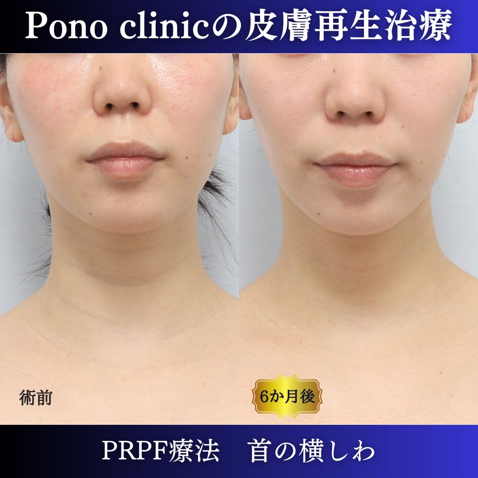 首のしわ、しわ治療、PRPF療法、30代の症例 (5)