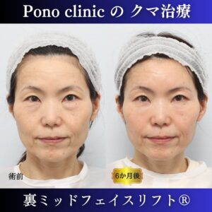 裏ミッドフェイスリフト、PRPF額こめかみ眉間 (7)