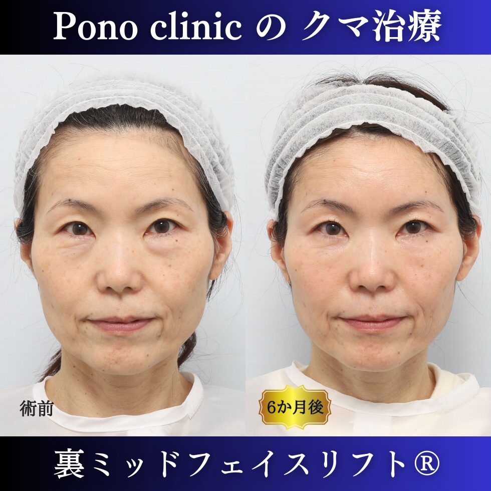 裏ミッドフェイスリフト、PRPF額こめかみ眉間 (7)