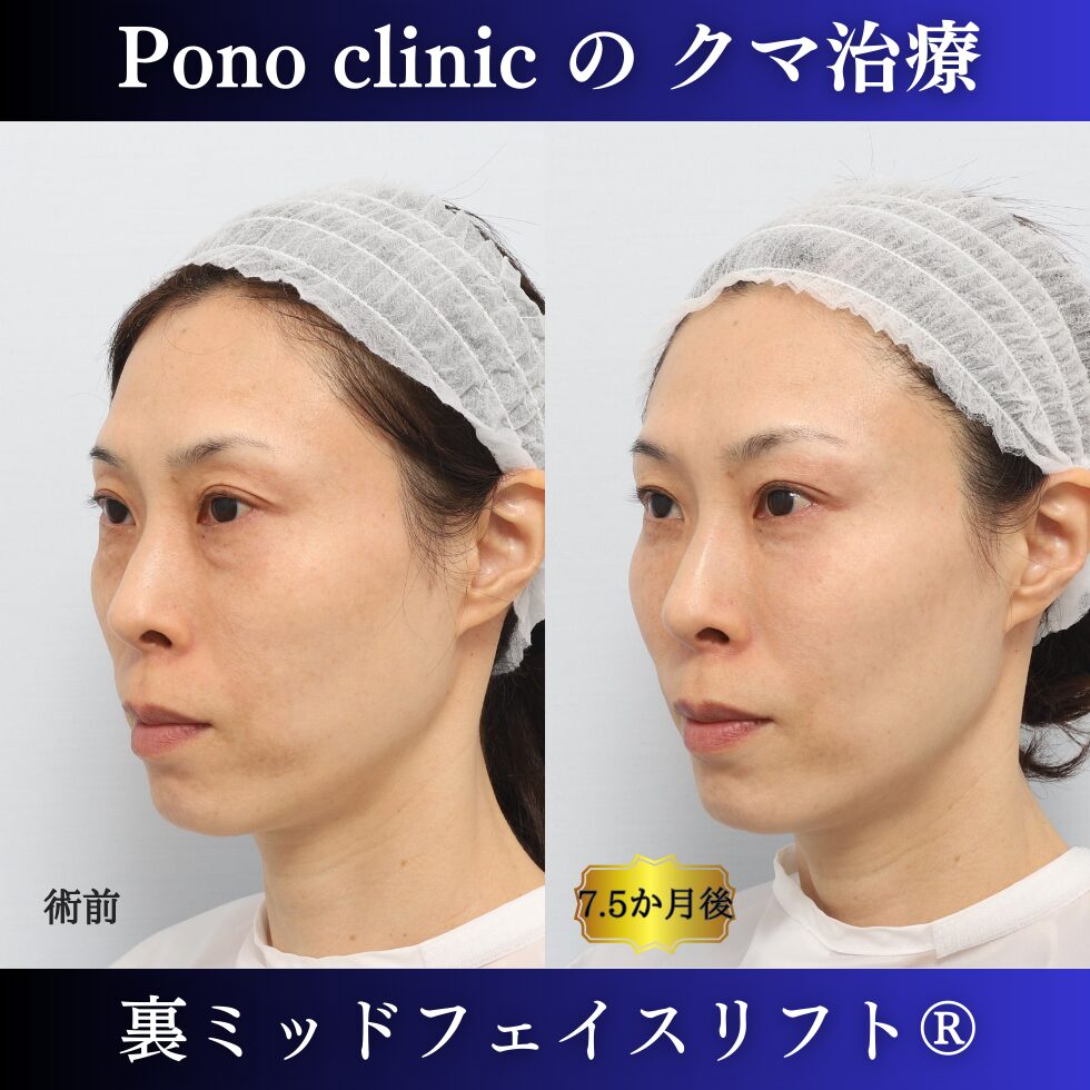 目の下のクマ治療、裏ハムラ、裏ミッドフェイスリフト、中顔面リフト、目の上のくぼみ、40代の症例 (4)