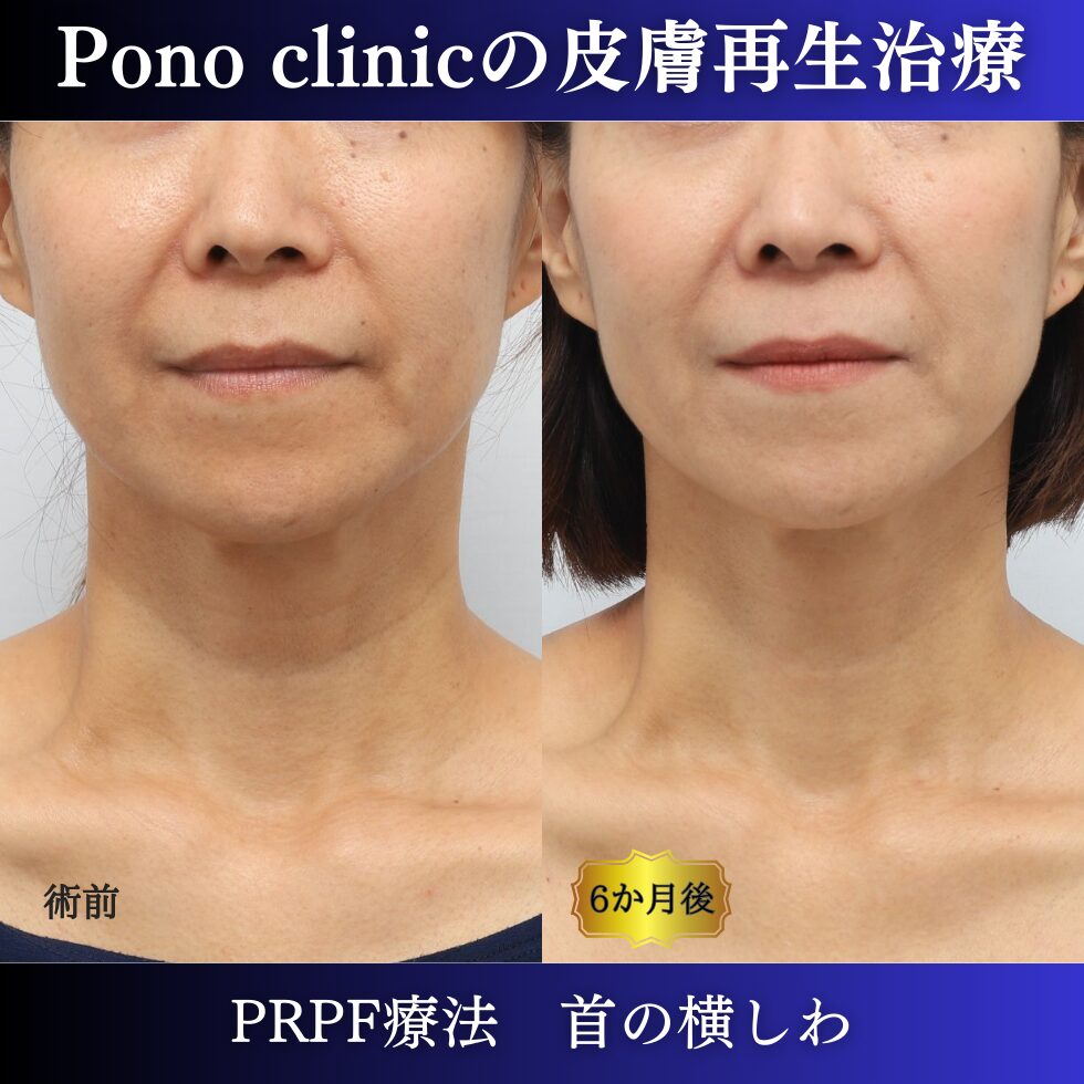 首のしわ、しわ治療、PRPF、50代の症例 (6)