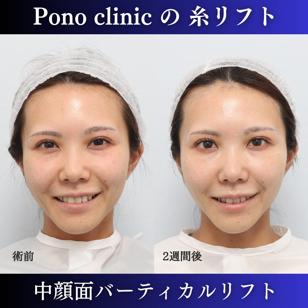 糸リフト、中顔面リフト、バーティカルリフト、小顔治療、20代の症例 (3)