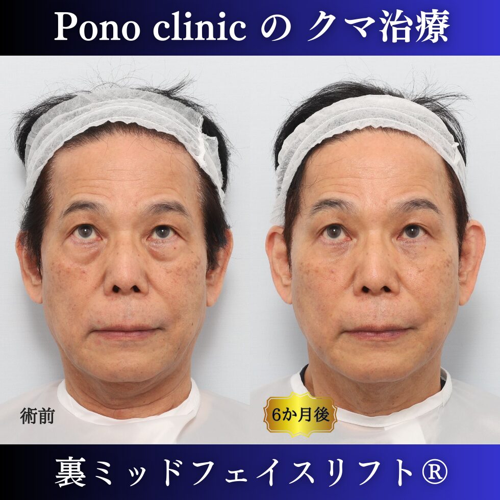 男性のクマ治療、50代の症例、目の下のたるみ、目の下のクマ、黒クマ (5)