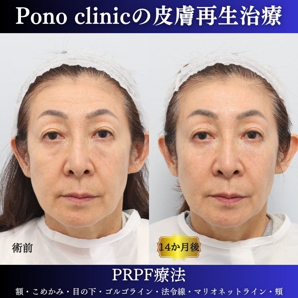 しわ治療、PRPF療法、額、こめかみ、目の下、ゴルゴライン、法令線、マリオネットライン、頬、60代の症例 (1)