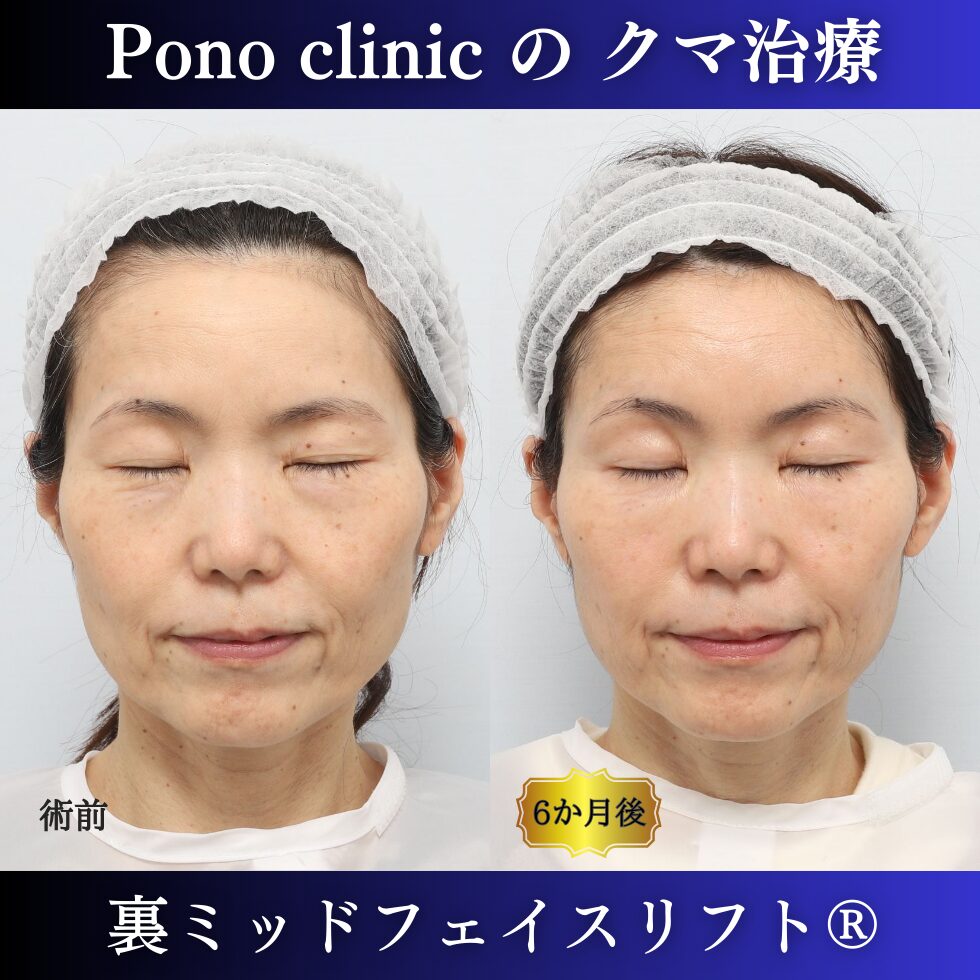 裏ミッドフェイスリフト、PRPF額こめかみ眉間 (6)